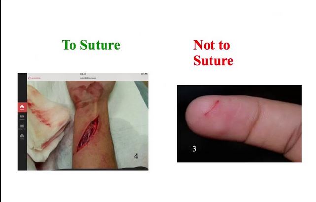 To Suture or Not to Suture