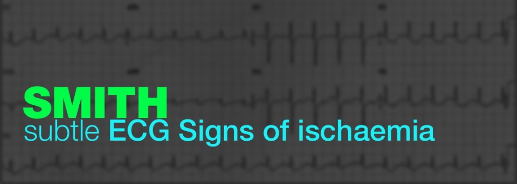 subtle ecg signs of ischemia by smith